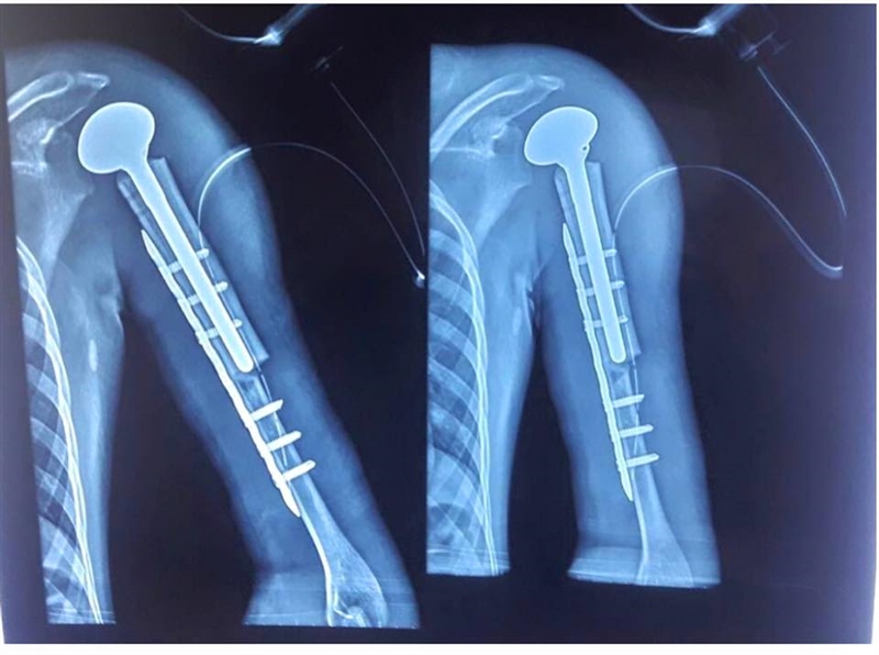 MEGAPROSTHESIS AND ALLOGRAFT PROSTHESIS COMPOSITE